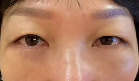術後