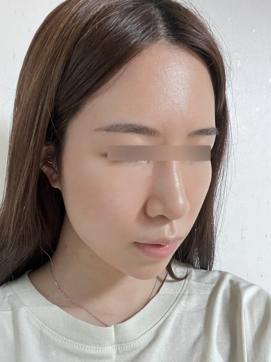 術後