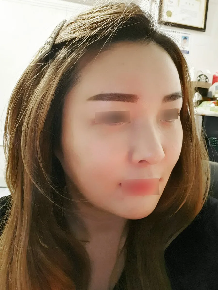 術後