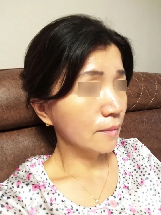術後