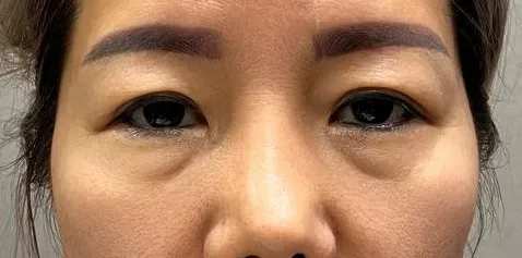 術前