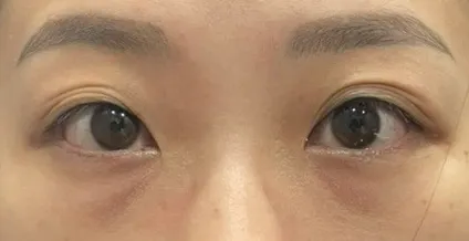 術前