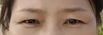術前