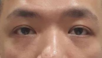術前