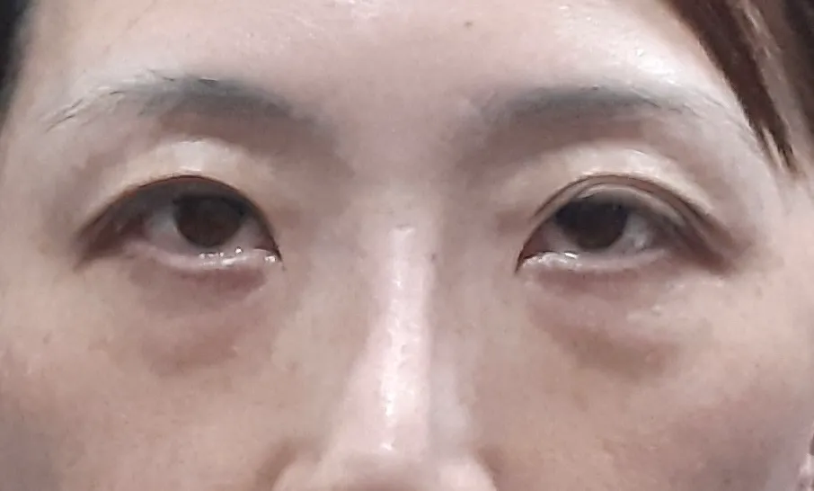 術前