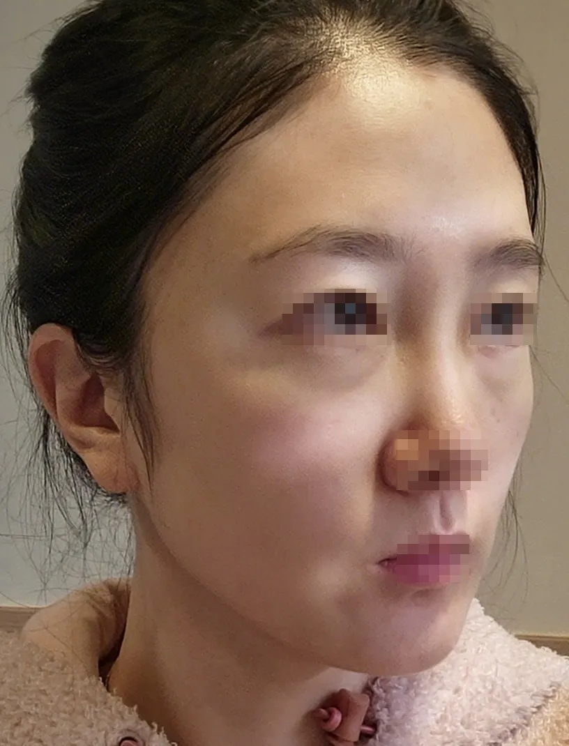 術前