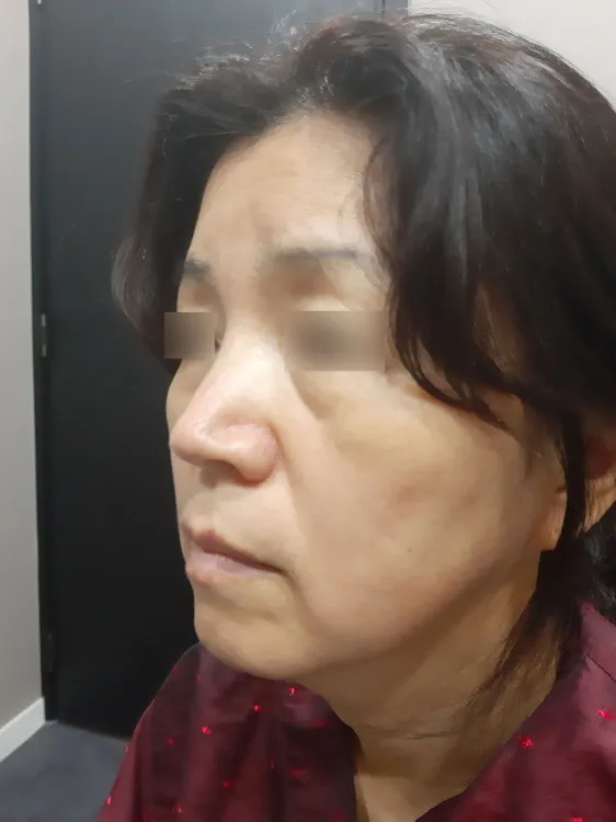 術前